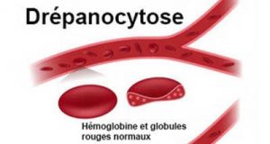 Drépanocytose : Une thérapie génique, réussi chez le premier patient traité