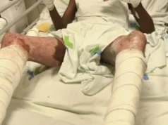 Togo / WACEM: Quand le Sang et la Sueur des Togolais Enrichissent les Indiens Un ouvrier de WACEM brûlé au 3e degré sur son lit d'hôpital, Togo | Photo: DR / Lalternative.info