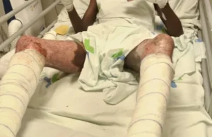 Togo / WACEM: Quand le Sang et la Sueur des Togolais Enrichissent les Indiens Un ouvrier de WACEM brûlé au 3e degré sur son lit d'hôpital, Togo | Photo: DR / Lalternative.info