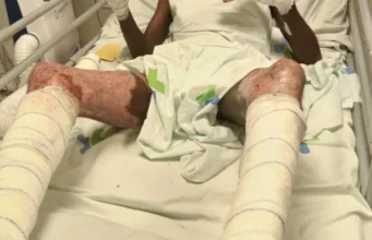 Togo / WACEM: Quand le Sang et la Sueur des Togolais Enrichissent les Indiens Un ouvrier de WACEM brûlé au 3e degré sur son lit d'hôpital, Togo | Photo: DR / Lalternative.info