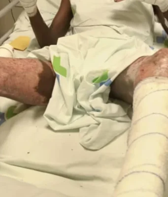 Togo / WACEM: Quand le Sang et la Sueur des Togolais Enrichissent les Indiens Un ouvrier de WACEM brûlé au 3e degré sur son lit d'hôpital, Togo | Photo: DR / Lalternative.info