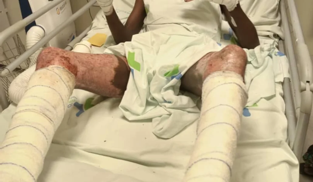 Un ouvrier de WACEM brûlé au 3e degré sur son lit d'hôpital, Togo | Photo: DR / Lalternative.info